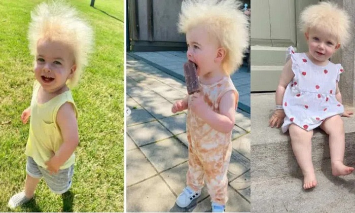  Two Babies Suffering From Uncombable Hair Syndome , Rare Disease, Uhs Dieseace,-TeluguStop.com