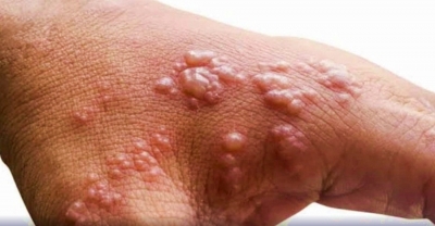  Eight-year-old In Andhra Found With Suspected Monkeypox Symptoms-TeluguStop.com