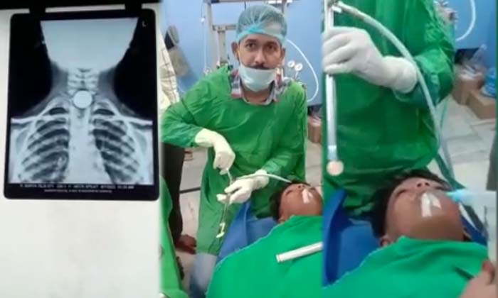  Five-year-old Boy Who Swallowed Rs 5 Coin , 5 Years Oid Boy , Swallowed Rs 5 Co-TeluguStop.com