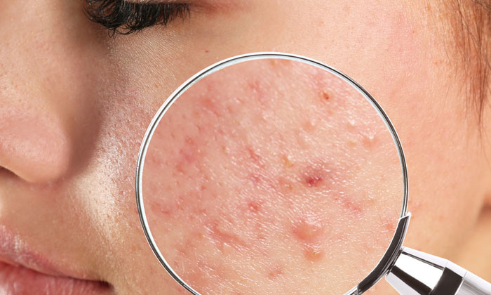  This Is A Powerful Remedy To Reduce Stubborn Acne! Stubborn Acne , Acne, Powerfu-TeluguStop.com