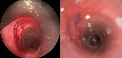  Sgpgims Doctors In Lucknow Perform Rare Bronchoscopic Removal Of Bullet-TeluguStop.com