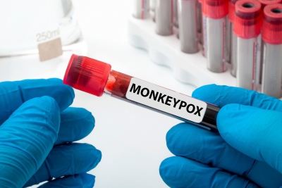 Us Reports Over 15,000 Monkeypox Cases Us Reports Over 15,000 Monkeypox Cases-TeluguStop.com