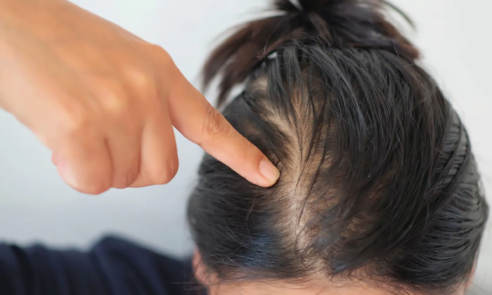  Effective Remedy To Get Rid Of Extreme Hair Fall!, Effective Remedy, Extreme Hai-TeluguStop.com
