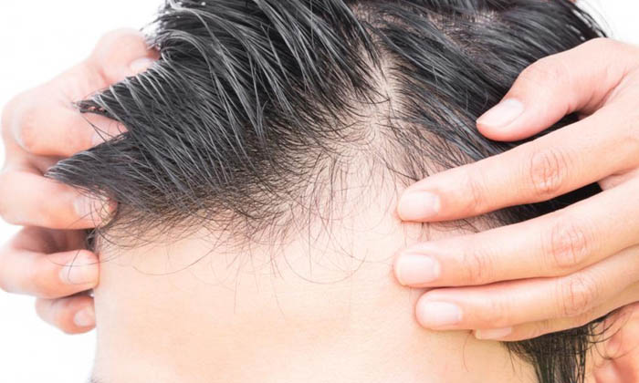 This Is An Effective Remedy To Prevent Hair Fall In Men! Home Remedy, Hair Pack,-TeluguStop.com