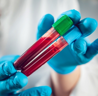  Simple Blood Test With Ai Help Can Predict Who Will Get Long Covid-TeluguStop.com