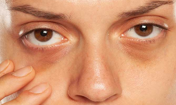  If You Follow That Tip, The Dark Circles Under The Eyes Will Disappear Within A-TeluguStop.com