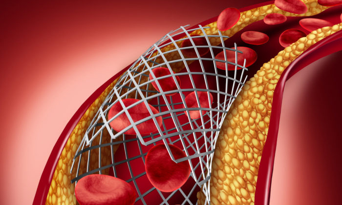 Telugu Bad Cholesterol, Cholesterol, Tips, Lipid Profile, Symptoms-Telugu Health