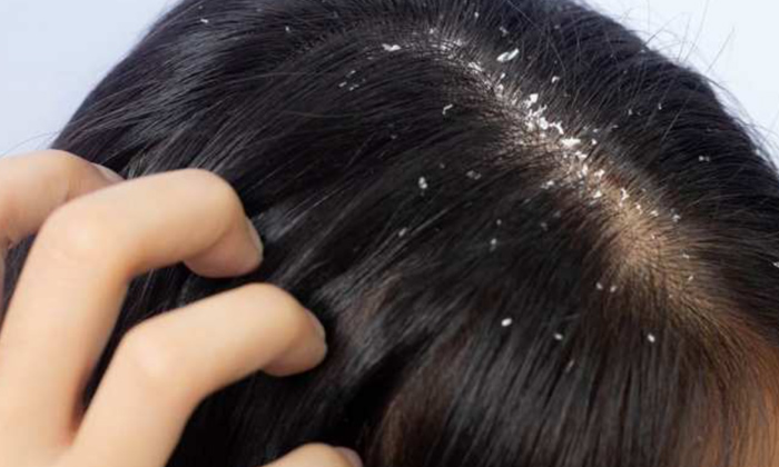  Garlic Helps To Get Rid Of Dandruff Effectively!, Garlic, Dandruff, Latest News,-TeluguStop.com