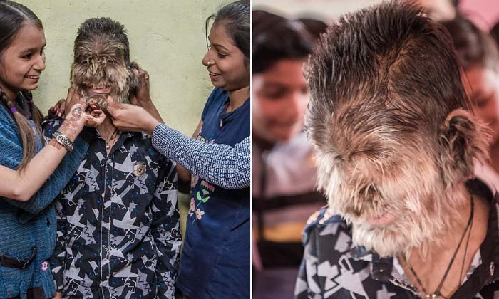  This Boy's Body Is Full Of Hair Like A Wolf , Werewolf Syndrome, Weird Diseases-TeluguStop.com