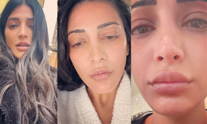 Shruthi Hassan Gets Alergyphotos Viral On Internet Details, Shruthi Hasan, Shrut Shruthi Hassan Gets Alergyphotos Viral On Internet Details, Shruthi Hasan, Shrut-TeluguStop.com