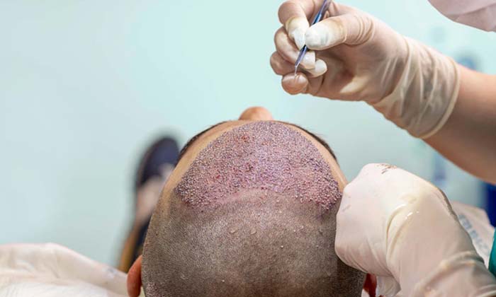  People Are Losing Their Lives Trying To Find Hair On Bald Places , Hair Transpla-TeluguStop.com