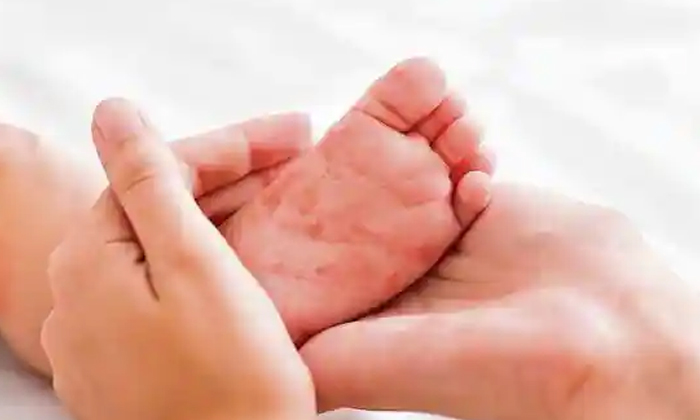 Measles Outbreak In India , Measles, India, Maharashtra, Gujarat, Jharkhand, He Measles Outbreak In India , Measles, India, Maharashtra, Gujarat, Jharkhand, He-TeluguStop.com