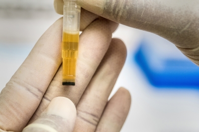  New Metabolite That Can Detect Liver Cancer By Urine Test Discovered-TeluguStop.com