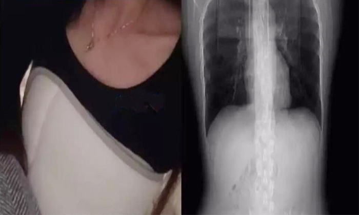  Woman In China Ribs Breaked While Coughing Details, Human Ribs, Skeleton Disease-TeluguStop.com