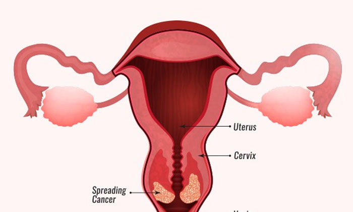 Telugu Cervical Cancer, Care, Tips, Healthy Foods, Latest-Latest News - Telugu