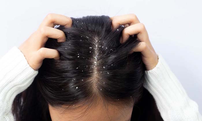  With These Two Ingredients You Can Easily Say Bye Bye To Dandruff Problem, Dandr-TeluguStop.com