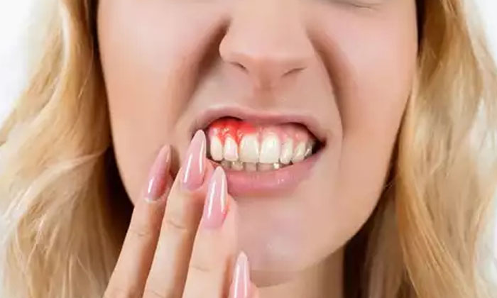 Telugu Tips, Remedy, Latest, Oral, Teeth, Teeth Remedy, Yellow Teeth-Telugu Heal