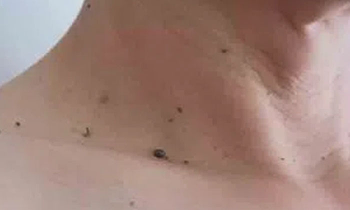 Telugu Cryotherapy, Dermatologist, Tips, Papillomavirus, Pimples, Skin, Skin Pro Telugu Cryotherapy, Dermatologist, Tips, Papillomavirus, Pimples, Skin, Skin Pro