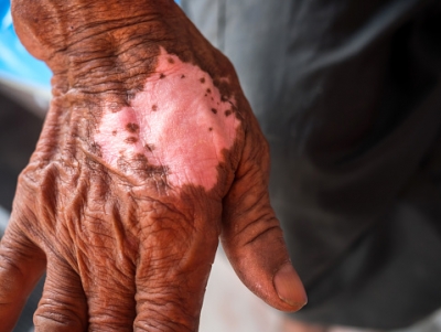  Tanzania Embarks On Programme To Eliminate Leprosy By 2030-TeluguStop.com