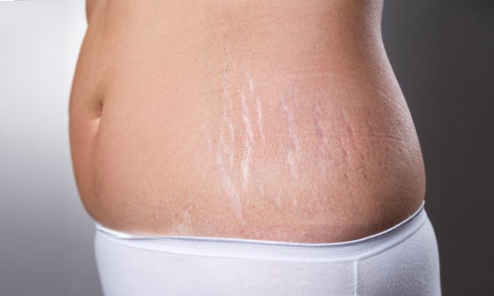  A Super Effective Remedy To Get Rid Of Stretch Marks On The Stomach Is For You D-TeluguStop.com