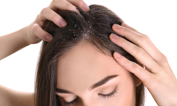  With These Two Ingredients You Can Get Rid Of Dandruff Easily Details! Dandruff,-TeluguStop.com