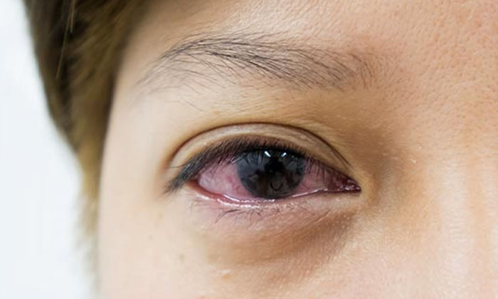 Telugu Anemia, Copper, Dates, Diabetes, Eyes, Eyes Problem, Tips, Immunity, Magn