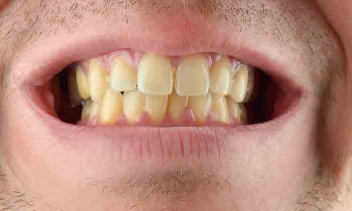  Do You Know How To Get Rid Of Yellow Teeth With Turmeric Yellow Teeth, Turmeric-TeluguStop.com
