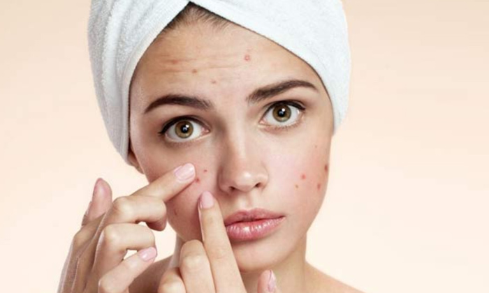  This Is The Powerful Remedy For Getting Clear Skin!, Powerful Remedy, Clear Skin-TeluguStop.com