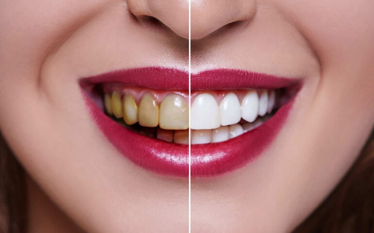  Simple Tips For Teeth Whitening! Simple Tips, Teeth Whitening, Latest News, Heal-TeluguStop.com