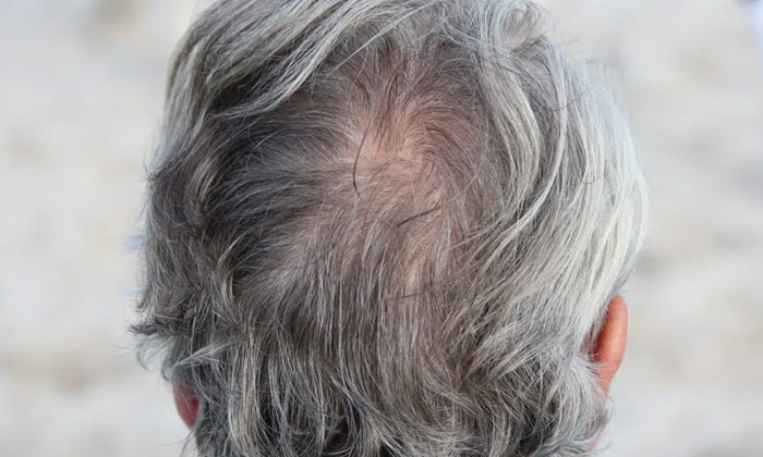 Do You Know The Reasons For Hair Turning Gray , Hair Turning Gray , New York Uni-TeluguStop.com