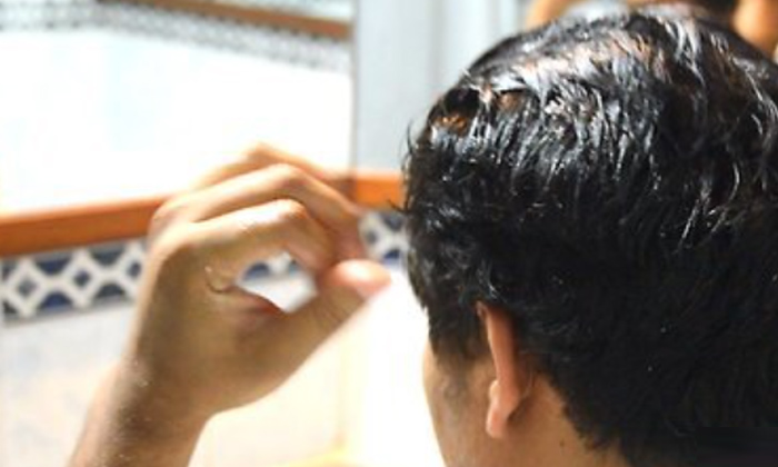 Telugu Baldness, Care, Care Tips, Fall, Remedy, Latest, Thick-Telugu Health