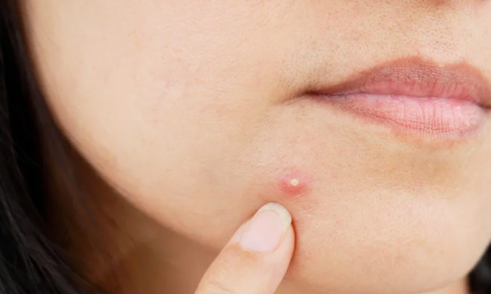  Follow This Simple Tip To Prevent Pimples!, Pimples, Simple Tip, Acne, Latest Ne-TeluguStop.com