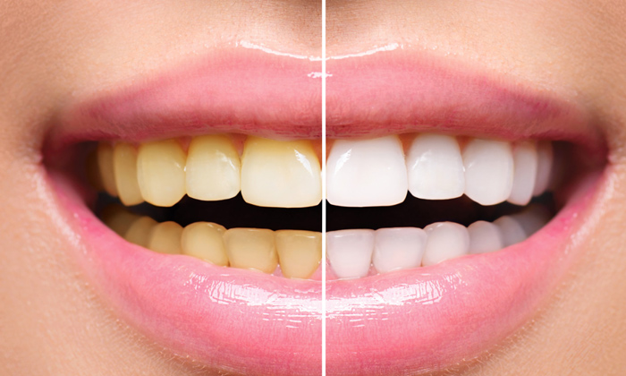  Best Way To Say Goodbye To Yellow Teeth!, Yellow Teeth, Home Remedy, Teeth White-TeluguStop.com