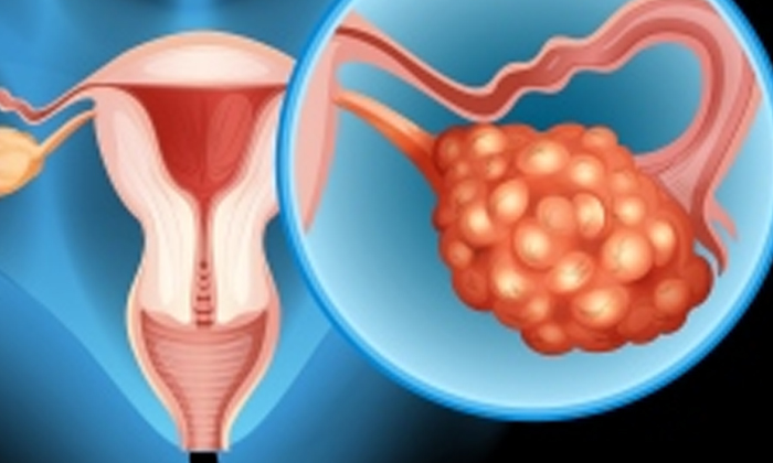 Telugu Abdominal Pain, Cancer, Tips, Ovarian Cancer-Telugu Health Tips