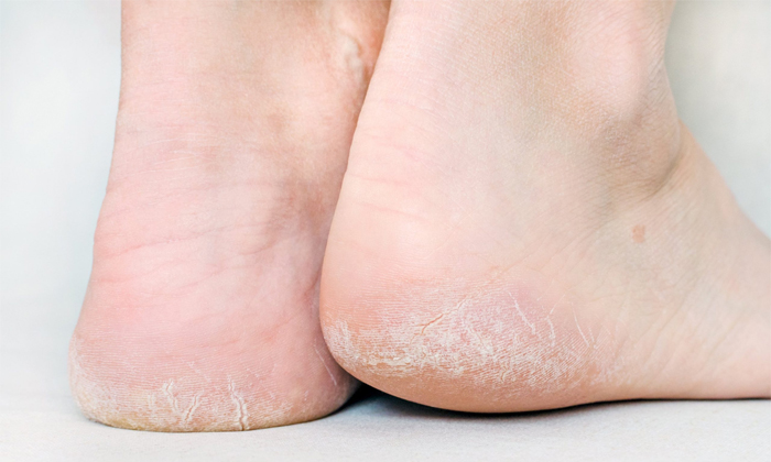  Just These Two Ingredients Helps To Reduce Cracked Feet Details! Cracked Feet, C-TeluguStop.com