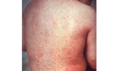  Measles Cases Near 1,000 In South Africa-TeluguStop.com