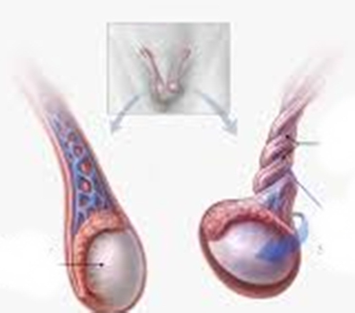  Torsion Of Testis In 18-year-old Corrected-TeluguStop.com