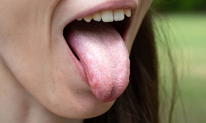 Telugu Detox, Tips, Illness, Telugu, Tongue, Tongue Color, White Tongue-Telugu H