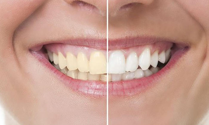  Try This Home Remedy For Teeth Whitening!, Home Remedy, Teeth Whitening, Latest-TeluguStop.com