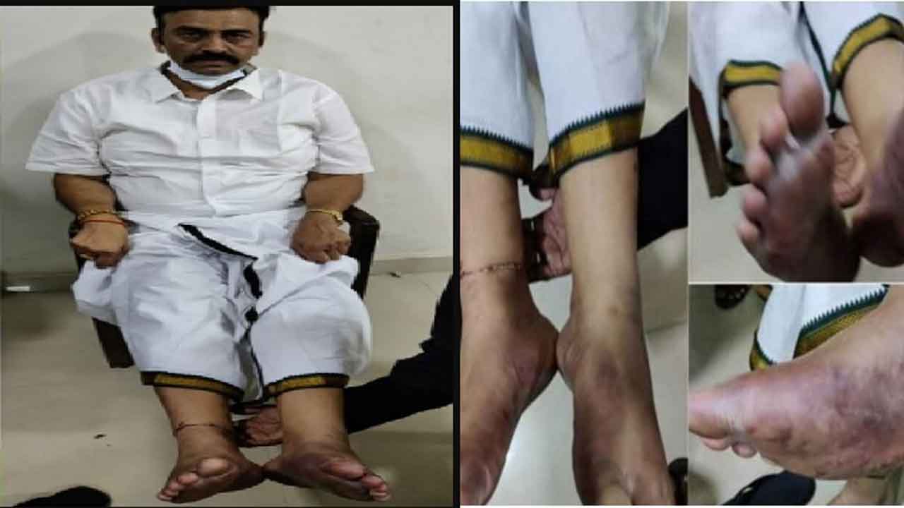  Custodial Torture : Ap Hc Orders Govt To Secure Mp Raghu Rama Raju Medical Repor-TeluguStop.com