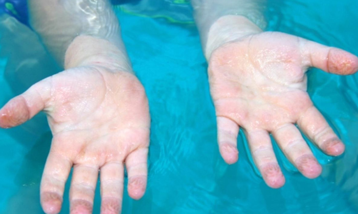 Telugu Tips, Hyperkeratosis, Keratin, Scientific, Telugu, Toes, Wrinkles-Telugu