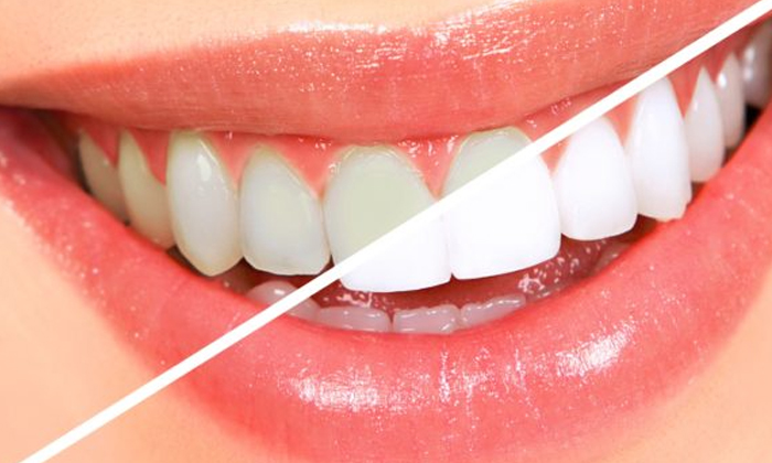 Telugu Tips, Healthy Teeth, Oral, Teeth-Telugu Health