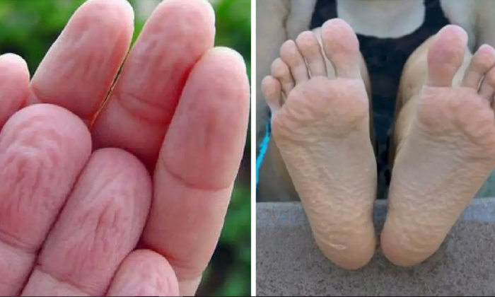  Why Do Fingers And Toes Wrinkle In Water,hyperkeratosis ,keratin,toes,wrinkles,s-TeluguStop.com