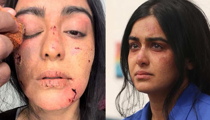  Adah Sharma Shares Wounded Photos Kerala Story Details, Adah Sharma, Wounded Pho-TeluguStop.com