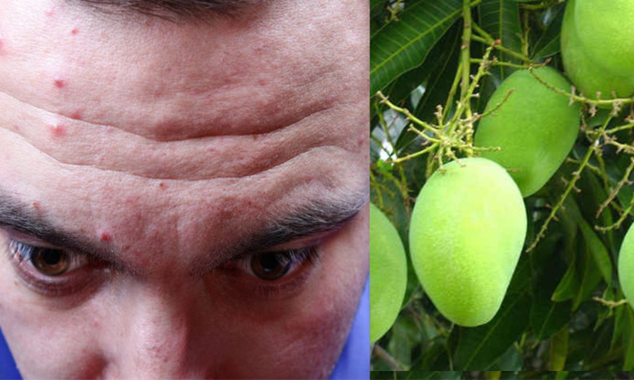  How To Treat Pimples After Eating Mangoes In Summer Details, Pimples, Mangoes, S-TeluguStop.com