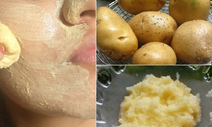 Telugu Acne, Tips, Clear Skin, Remedy, Latest, Pimples, Simple Remedy, Skin Care