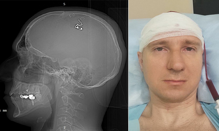  Russian Man Almost Dies After Drilling Chip Inside Brain In Surgery At Home Deta-TeluguStop.com