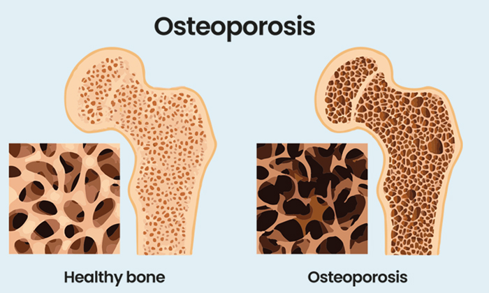 Telugu Care, Tips, Healthy, Occurs, Osteoporosis-Latest News - Telugu