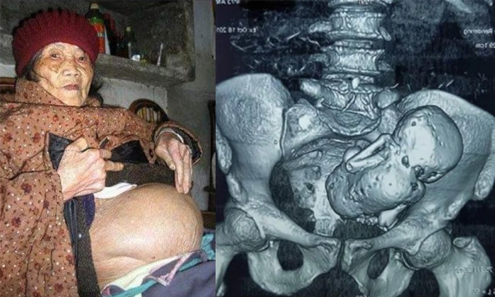 Telugu Pregnant, Carry, Chinese, Fetus, Huang Yijun, Poor, Pregnancy, Stone Baby Telugu Pregnant, Carry, Chinese, Fetus, Huang Yijun, Poor, Pregnancy, Stone Baby