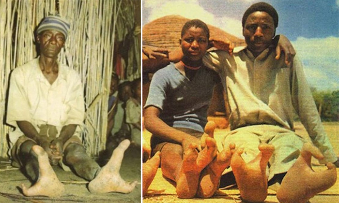  The Vadoma Tribe Of Zimbabwe Has Two-toed Population Due To A Rare Genetic Condi-TeluguStop.com